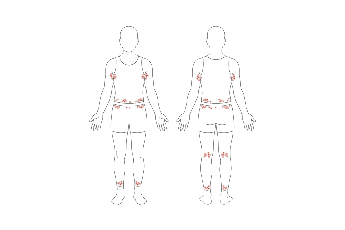 Chigger Control 21 Front and back body outline with red bite clusters at the ankles, behind the knees, along the waistband and in the armpits